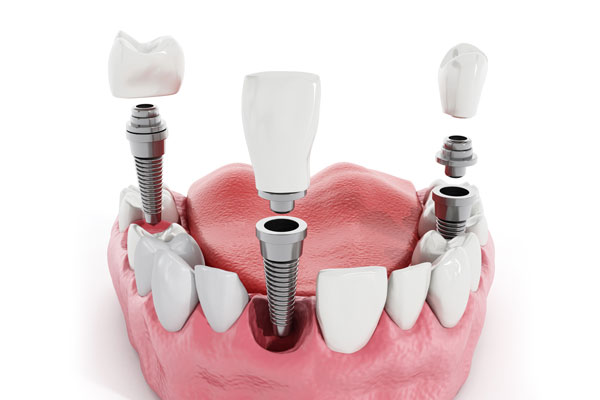 Dental Implants Md V2.jpg